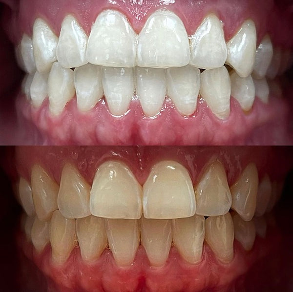 Teeth Whitening Training Course